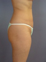 Liposuction Before and after photo