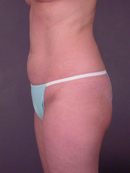 Liposuction before and after photo