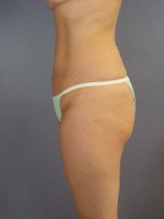 Liposuction Before and after photo