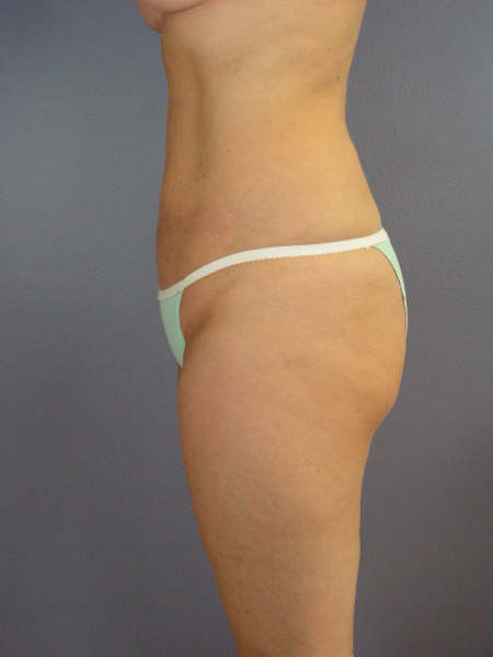 Liposuction before and after photo