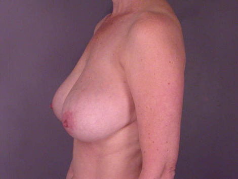 Liposuction before and after photo