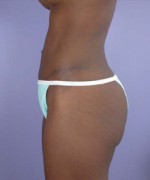 Liposuction Before and after photo