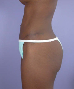 Liposuction before and after photo