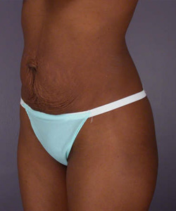 Liposuction before and after photo