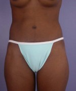 Liposuction Before and after photo