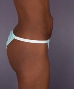 Liposuction Before and after photo