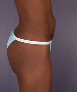 Liposuction before and after photo