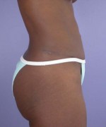 Liposuction Before and after photo