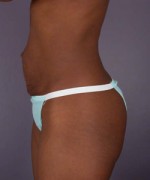 Liposuction Before and after photo