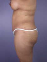 Liposuction Before and after photo