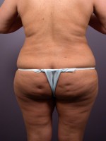 Liposuction Before and after photo