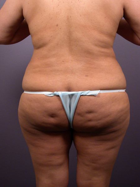 Liposuction before and after photo