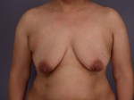 Liposuction Before and after photo