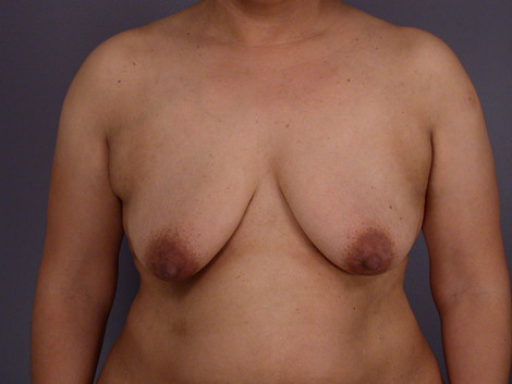 Liposuction before and after photo