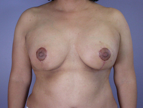 Liposuction before and after photo