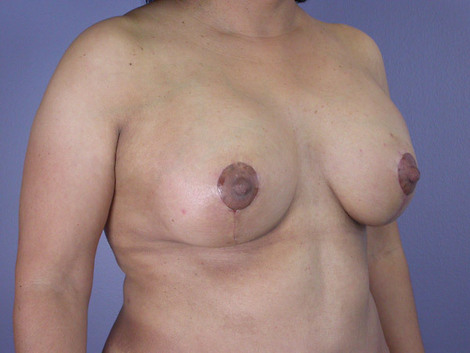 Liposuction before and after photo