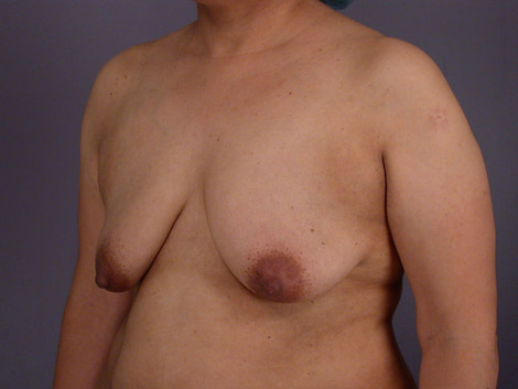 Liposuction before and after photo