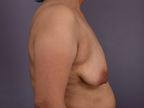 Liposuction before and after photo