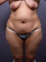 Liposuction Before and after photo