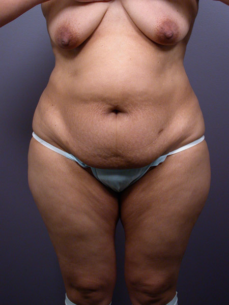 Liposuction before and after photo