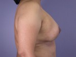 Liposuction Before and after photo