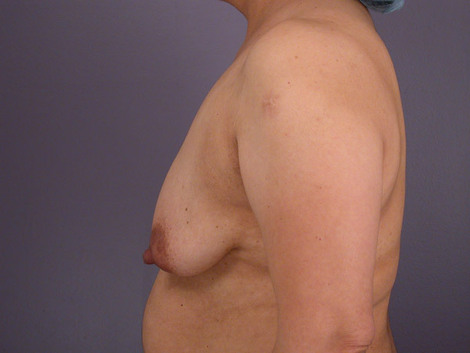 Liposuction before and after photo