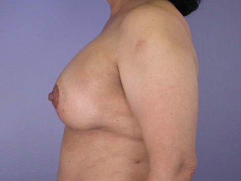 Liposuction before and after photo