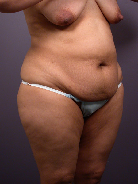 Liposuction before and after photo