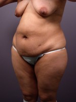 Liposuction Before and after photo