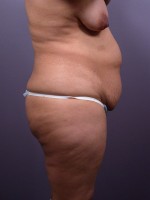 Liposuction Before and after photo