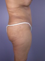 Liposuction Before and after photo