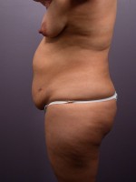 Liposuction Before and after photo