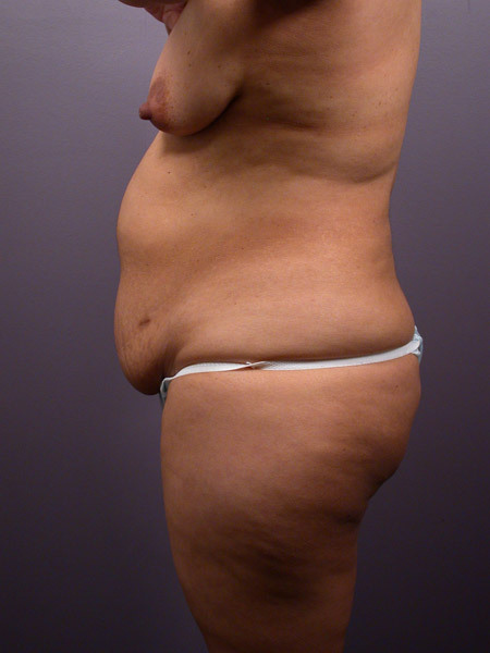 Liposuction before and after photo