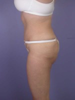 Liposuction Before and after photo