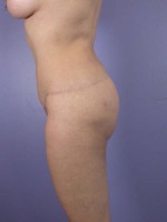 Liposuction Before and after photo