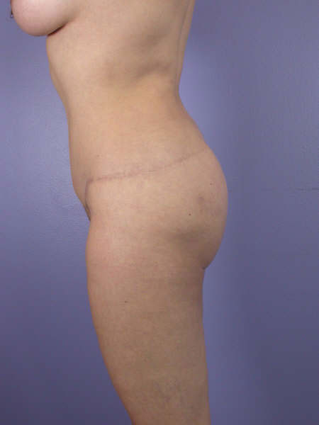 Liposuction before and after photo