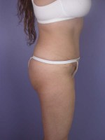 Liposuction Before and after photo