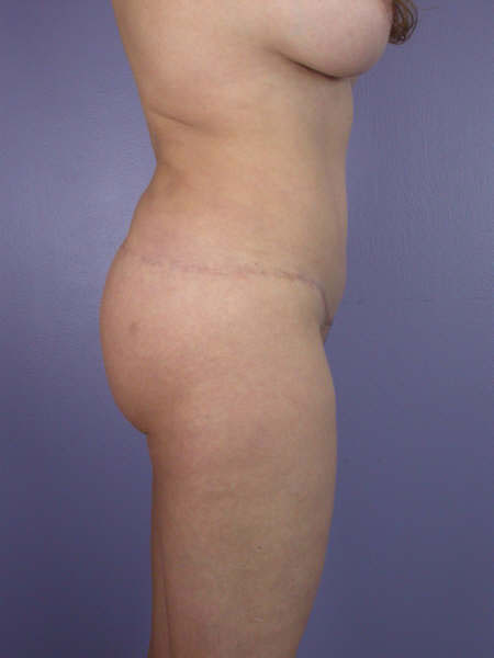 Liposuction before and after photo