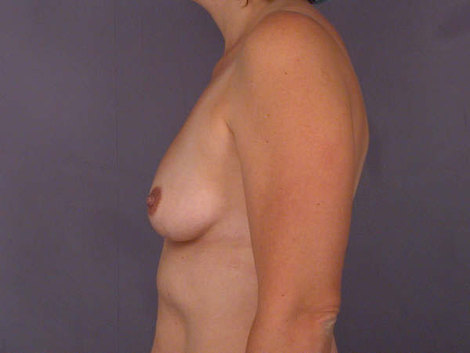 Liposuction before and after photo