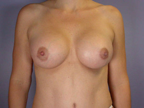 Liposuction before and after photo