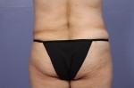 Liposuction Before and after photo