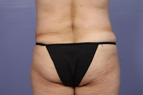 Liposuction before and after photo