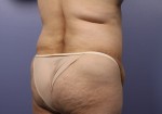 Liposuction Before and after photo