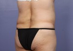 Liposuction Before and after photo