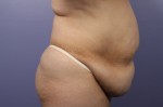 Liposuction Before and after photo