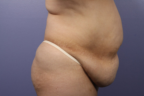 Liposuction before and after photo