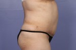 Liposuction Before and after photo