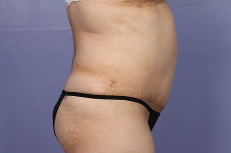 Liposuction before and after photo