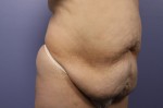 Liposuction Before and after photo