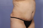 Liposuction Before and after photo